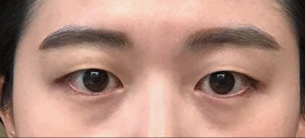 dark circle removal in korea made young